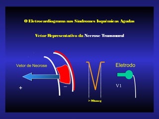+
_
Vetor de Necrose
O Eletrocardiograma nas Síndromes Isquêmicas Agudas
Eletrodo
V1
> 90mseg
VetorRepresentativo da Necrose Transmural
 
