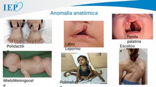 Anomalia anatômica
Polidactili
a
MieloMeningocel
e
Lábio
Leporino
Fenda
palatina
Escolios
e
Polimeli
 