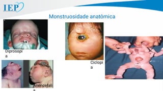 Monstruosidade anatômica
Diprosopi
a
Gêmeos
Ciclopi
a
Anencefali
 