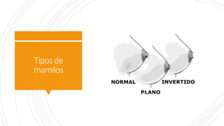 Tipos de
mamilos
 