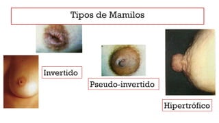 Invertido
Pseudo-invertido
Hipertrófico
Tipos de Mamilos
 