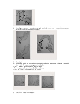 2- Com relação à ação que a musculatura da região mandibular exerce sobre o foco de fratura, podendo
ser classificada em favorável e não-favoravel:
3- Com relação à
4- presença de dentes no foco de fratura, o qual pode auxiliar na estabilização da mesma, Kazanjian e
Converse (1949) propuserama seguinte classificação:
-Classe I: presença de dentes nos dois lados da fratura;
-Classe II: presença de dentes emumdos lados da fratura;
-Classe III: Ausência de dentes no local das fraturas.
5- Com relação ao grau de severidade:
 