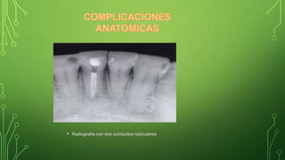 • Radiografia con dos conductos radiculares
 