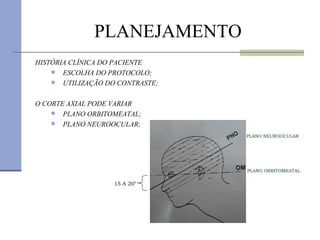 PLANEJAMENTO HISTÓRIA CLÍNICA DO PACIENTE ESCOLHA DO PROTOCOLO; UTILIZAÇÃO DO CONTRASTE; O CORTE AXIAL PODE VARIAR PLANO ORBITOMEATAL; PLANO NEUROOCULAR; PLANO NEUROOCULAR PLANO ORBITOMEATAL 15 A 20° 