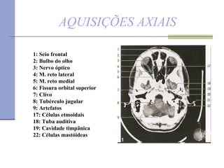 AQUISIÇÕES AXIAIS 1: Seio frontal 2: Bulbo do olho 3: Nervo óptico  4: M. reto lateral 5: M. reto medial  6: Fissura orbital superior 7: Clivo  8: Tubérculo jugular  9: Artefatos  17: Células etmoidais 18: Tuba auditiva  19: Cavidade timpânica 22: Células mastóideas 