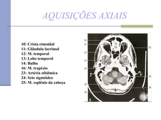 AQUISIÇÕES AXIAIS 10: Crista etmoidal  11: Glândula lacrimal  12: M. temporal  13: Lobo temporal  14: Bulbo   16: M. trapézio 23: Artéria oftálmica  24: Seio sigmóideo  25: M. esplênio da cabeça  