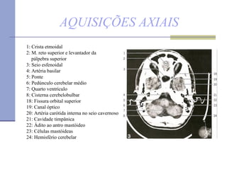 AQUISIÇÕES AXIAIS 1: Crista etmoidal  2: M. reto superior e levantador da  pálpebra superior 3: Seio esfenoidal  4: Artéria basilar  5: Ponte 6: Pedúnculo cerebelar médio 7: Quarto ventrículo  8: Cisterna cerebelobulbar 18: Fissura orbital superior 19: Canal óptico  20: Artéria carótida interna no seio cavernoso  21: Cavidade timpânica 22: Ádito ao antro mastóideo 23: Células mastóideas  24: Hemisfério cerebelar 