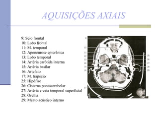 AQUISIÇÕES AXIAIS 9: Seio frontal  10: Lobo frontal  11: M. temporal 12: Aponeurose epicrânica 13: Lobo temporal  14: Artéria carótida interna 15: Artéria basilar  16: Artefato  17: M. trapézio 25: Hipófise  26: Cisterna pontocerebelar  27: Artéria e veia temporal superficial 28: Orelha 29: Meato acústico interno   