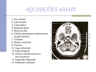 AQUISIÇÕES AXIAIS 1: Seio frontal  2: Lobo frontal 3: Canal óptico  4: Quiasma óptico 5: Dorso da sela  6: Células pneumáticas anteriormente  na parte petrosa  7: Artefatos  8: Quarto ventrículo 9: Cisterna 12: Jugo esfenoidal  13: Lobo temporal  14: Artéria carótida interna no  seio cavernoso  15: Impressão trigeminal  16: Pedúnculo cerebelar 
