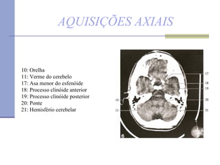 AQUISIÇÕES AXIAIS 10: Orelha  11: Verme do cerebelo 17: Asa menor do esfenóide  18: Processo clinóide anterior  19: Processo clinóide posterior  20: Ponte  21: Hemisfério cerebelar 