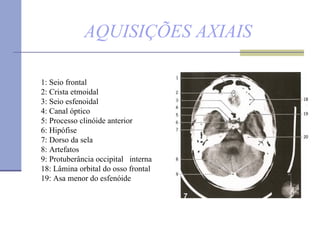 AQUISIÇÕES AXIAIS 1: Seio frontal  2: Crista etmoidal 3: Seio esfenoidal 4: Canal óptico  5: Processo clinóide anterior 6: Hipófise  7: Dorso da sela 8: Artefatos  9: Protuberância occipital  interna  18: Lâmina orbital do osso frontal  19: Asa menor do esfenóide 