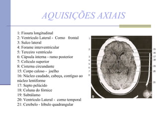 AQUISIÇÕES AXIAIS 1: Fissura longitudinal  2: Ventrículo Lateral -  Corno  frontal  3: Sulco lateral  4: Forame interventricular  5: Terceiro ventrículo  6: Cápsula interna - ramo posterior  7: Colículo superior  8: Cisterna circundante 15: Corpo caloso -  joelho  16: Núcleo caudado, cabeça, contíguo ao  núcleo lentiforme 17: Septo pelúcido  18: Coluna do fórnice 19: Subtálamo  20: Ventrículo Lateral -  corno temporal 21: Cerebelo - lóbulo quadrangular 