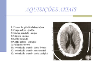 AQUISIÇÕES AXIAIS 1: Fissura longitudinal do cérebro 2: Corpo caloso - joelho  3: Núcleo caudado - corpo 4: Cápsula interna  5: Septo pelúcido  6: Corpo caloso - esplênio  7: Foice do cérebro 11: Ventrículo lateral - corno frontal  12: Ventrículo lateral - parte central  13: Ventrículo lateral - corno occipital 