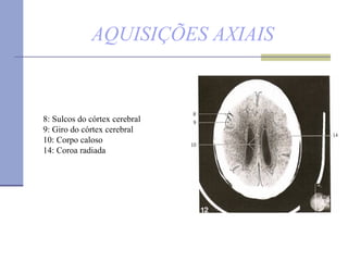 AQUISIÇÕES AXIAIS 8: Sulcos do córtex cerebral 9: Giro do córtex cerebral  10: Corpo caloso 14: Coroa radiada  