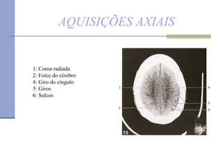 AQUISIÇÕES AXIAIS 1: Coroa radiada  2: Foice do cérebro 4: Giro do cíngulo  5: Giros 6: Sulcos 