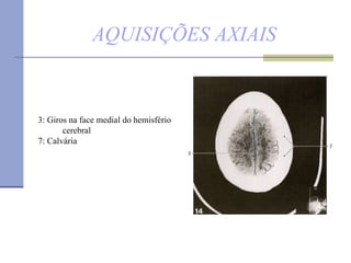 AQUISIÇÕES AXIAIS 3: Giros na face medial do hemisfério  cerebral 7: Calvária 