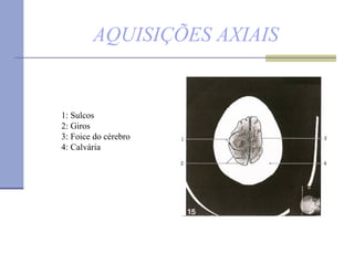 AQUISIÇÕES AXIAIS 1: Sulcos 2: Giros  3: Foice do cérebro  4: Calvária 