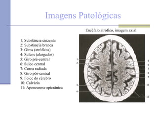 Imagens Patológicas 1: Substância cinzenta 2: Substância branca  3: Giros (atróficos)  4: Sulcos (alargados)  5: Giro pré-central 6: Sulco central  7: Coroa radiada 8: Giro pós-central  9: Foice do cérebro 10: Calvária  11: Aponeurose epicrânica  Encéfalo atrófico, imagem axial 