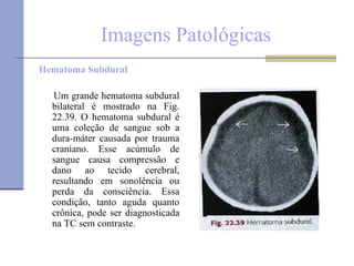 Imagens Patológicas Hematoma Subdural  Um grande hematoma subdural bilateral é mostrado na Fig. 22.39. O hematoma subdural é uma coleção de sangue sob a dura-máter causada por trauma craniano. Esse acúmulo de sangue causa compressão e dano ao tecido cerebral, resultando em sonolência ou perda da consciência. Essa condição, tanto aguda quanto crônica, pode ser diagnosticada na TC sem contraste.  