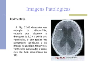 Imagens Patológicas Hidrocefalia  A Fig. 22.40 demonstra um exemplo de hidrocefalia, causada por bloqueio à drenagem de LCR a partir dos ventrículos, o que resulta em aumentados ventrículos e da pressão no encéfalo. Observe os ventrículos aumentados e como eles são bem visualizados na TC. 