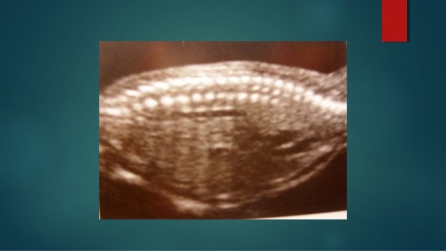 Anatomia e ultrassom da coluna vertebral fetal Anatomia e ultrassom da coluna vertebral fetal