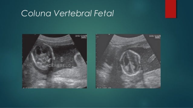 Anatomia e ultrassom da coluna vertebral fetal Anatomia e ultrassom da coluna vertebral fetal