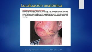 Localización anatómica
Gloster, Hugs M. Complications in cutaneous surgery. 1ª Edic. Ed. Springer; 2008
 