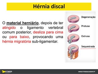 O material herniário, depois de ter
atingido o ligamento vertebral
comum posterior, desliza para cima
ou para baixo, provocando uma
hérnia migratória sub-ligamentar.
Hérnia discal
 