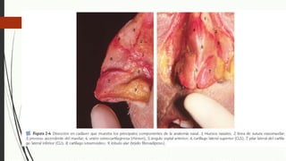 Anatomía vascular
Plexos
Plexo Keisselbach´s
• Esfenopalatina
• Palatina mayor
• Labial superior
• Etmoidal anterior
 