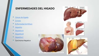 ENFERMEDADES DEL HIGADO
• Cáncer de hígado
• Cirrosis
• Enfermedad deWilson
• Hepatitis
• Hepatitis A
• Hepatitis B
• Hepatitis C
• Carcinoma Hepatico
 