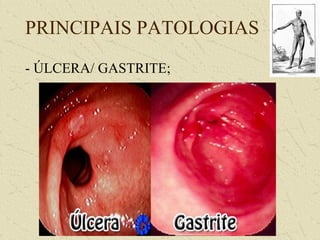 PRINCIPAIS PATOLOGIAS
- ÚLCERA/ GASTRITE;
 