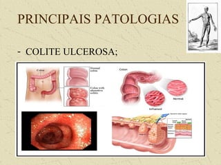 PRINCIPAIS PATOLOGIAS
- COLITE ULCEROSA;
 