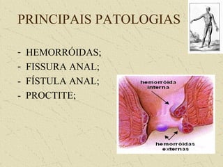PRINCIPAIS PATOLOGIAS
- HEMORRÓIDAS;
- FISSURA ANAL;
- FÍSTULA ANAL;
- PROCTITE;
 