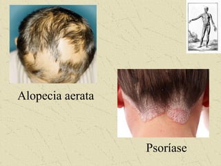 Alopecia aerata
Psoríase
 
