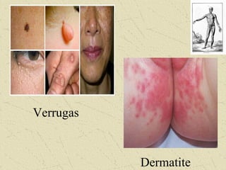 Verrugas
Dermatite
 