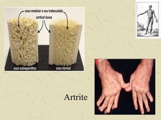 Artrite
 
