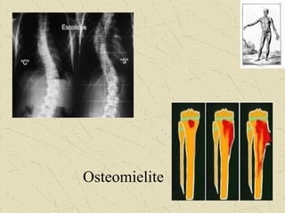 Osteomielite
 