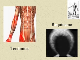 Tendinites
Raquitismo
 
