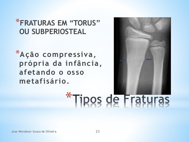 Anatomia Radiologica Tipos De Fraturas Achados Radiograficos