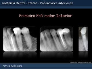 Patrícia Ruiz Spyere
Anatomia Dental Interna – Pré-molares inferiores
Primeiro Pré-molar Inferior
LEMOS, 2014; SOARES; GOLDBERG, 2002
 