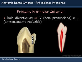 Patrícia Ruiz Spyere
Anatomia Dental Interna – Pré-molares inferiores
Primeiro Pré-molar Inferior
 Dois divertículos  V (bem pronunciado) e L
(extremamente reduzido)
LEMOS, 2014; SOARES; GOLDBERG, 2002
 