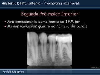 Patrícia Ruiz Spyere
Anatomia Dental Interna – Pré-molares inferiores
Segundo Pré-molar Inferior
 Anatomicamente semelhante ao 1 PM inf
 Menos variações quanto ao número de canais
LEMOS, 2014
 