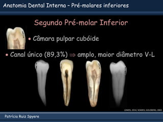 Patrícia Ruiz Spyere
Anatomia Dental Interna – Pré-molares inferiores
Segundo Pré-molar Inferior
 Câmara pulpar cubóide
LEMOS, 2014; SOARES; GOLDBERG, 2002
 Canal único (89,3%)  amplo, maior diâmetro V-L
 