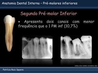 Patrícia Ruiz Spyere
Anatomia Dental Interna – Pré-molares inferiores
Segundo Pré-molar Inferior
 Apresenta dois canais com menor
frequência que o 1 PM inf (10,7%)
LEMOS, 2014; SOARES; GOLDBERG, 2002
 