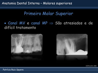 Patrícia Ruiz Spyere
Anatomia Dental Interna – Molares superiores
Primeiro Molar Superior
CASTELLUCCI, 2009
 Canal MV e canal MP  São atresiados e de
difícil tratamento
 