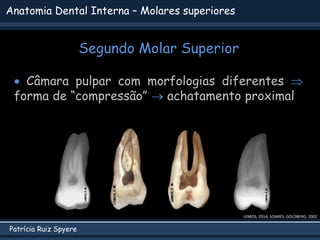 Patrícia Ruiz Spyere
Anatomia Dental Interna – Molares superiores
Segundo Molar Superior
LEMOS, 2014; SOARES; GOLDBERG, 2002
 Câmara pulpar com morfologias diferentes 
forma de “compressão”  achatamento proximal
 