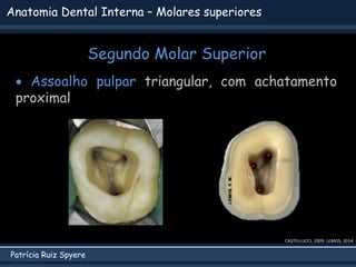 Patrícia Ruiz Spyere
Anatomia Dental Interna – Molares superiores
Segundo Molar Superior
CASTELLUCCI, 2009; LEMOS, 2014
 Assoalho pulpar triangular, com achatamento
proximal
 