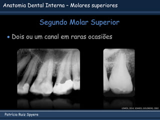 Patrícia Ruiz Spyere
Anatomia Dental Interna – Molares superiores
Segundo Molar Superior
 Dois ou um canal em raras ocasiões
LEMOS, 2014; SOARES; GOLDBERG, 2002
 