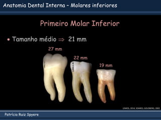 Patrícia Ruiz Spyere
Anatomia Dental Interna – Molares inferiores
 Tamanho médio  21 mm
LEMOS, 2014; SOARES; GOLDBERG, 2002
22 mm
19 mm
27 mm
Primeiro Molar Inferior
 