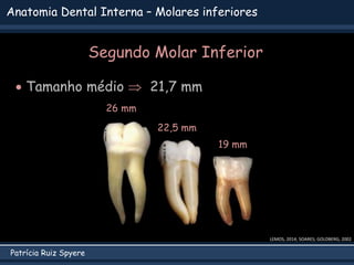 Patrícia Ruiz Spyere
Anatomia Dental Interna – Molares inferiores
 Tamanho médio  21,7 mm
LEMOS, 2014; SOARES; GOLDBERG, 2002
22,5 mm
19 mm
26 mm
Segundo Molar Inferior
 